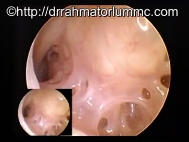 Middle Ear Cavity-The Hypotympanum