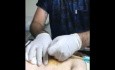 PEG Tube Removal