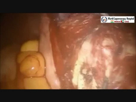 Robotic Myomectomy