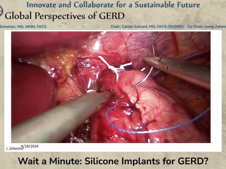 Wait a Minute - Silicone Implants for GERD?