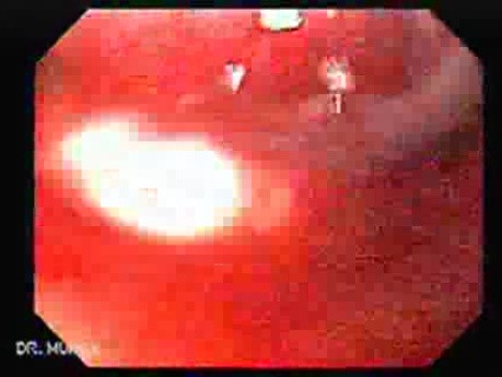 Adenocarcinoma of the Antrum and Incisura Angularis (1 of 3)