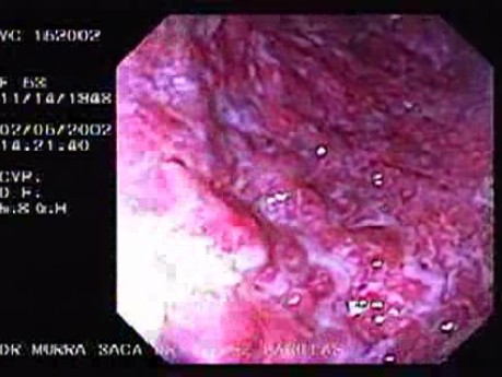 Severe Case Of Ulcerative Colitis (1 of 6)