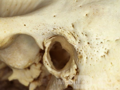 The Tympanic Bone