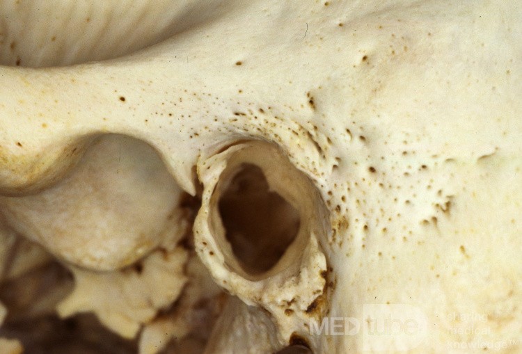 The Tympanic Bone