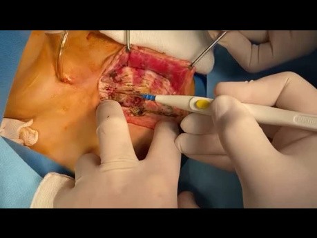 In This Video We Show You How to Manage ASD and VSD and Tracheal Stenosis Due to Chronic Intubation