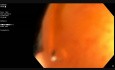 EMR in the Cecum