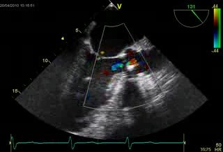 Aortic Stenosis