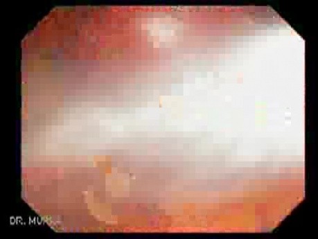 Giant Tubulo - Villous Adenoma (8 of 17)