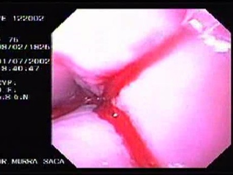 Hemorrhage Due Status Post Rubber Band Ligation of Esophageal Varices - Bleeding After Sclerotherapy