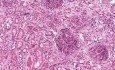 Kidney - Microscopic Polyarteritis