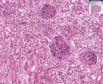 Kidney - Microscopic Polyarteritis