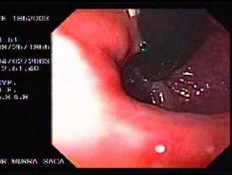 Banding of Esophageal Varices - Retroflexed View After Performed Banding