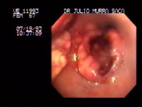 Esophageal Squamous Cell Carcinoma - case 1