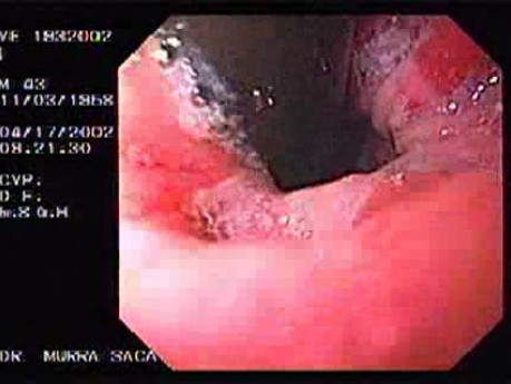 Barrett´s Esophagus - retroflexed image (2 of 2)