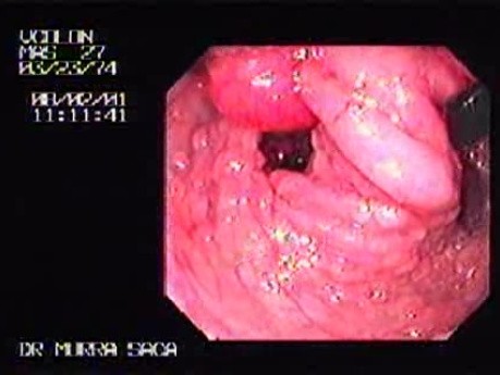 Familial Adenomatous Polyposis of the Colon (10 of 29)