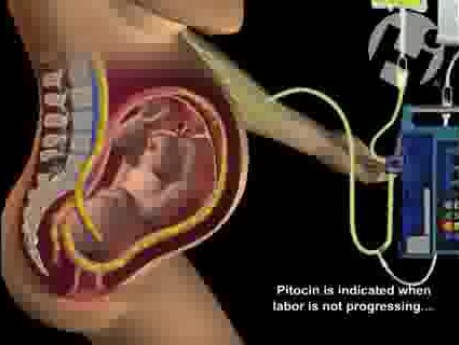 Effects of Pitocin on Uterine Contractions