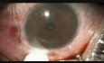 Juvenile Glaucoma, Singh-Shah Microtrack Filtration