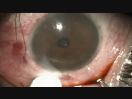 Juvenile Glaucoma, Singh-Shah Microtrack Filtration