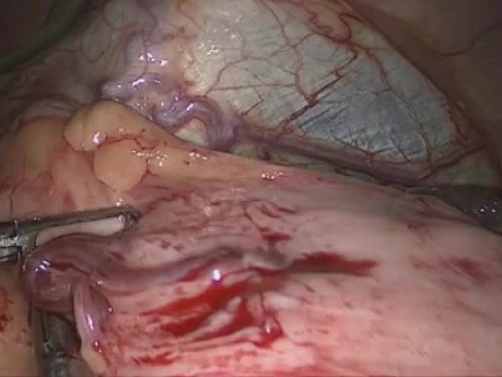 Laparoscopic Revision Heller's Cardiomyotomy
