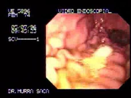 Gastroscopy