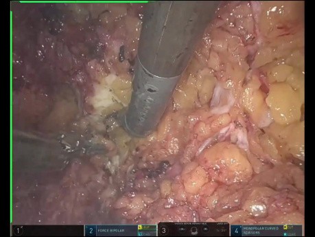 Uniportal Robotic Assisted Mastectomy (U-RABS)