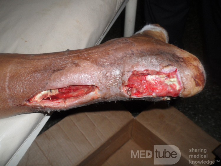 Necrotizing Fascitis At The Achill's Tendon In Diabetic Patient