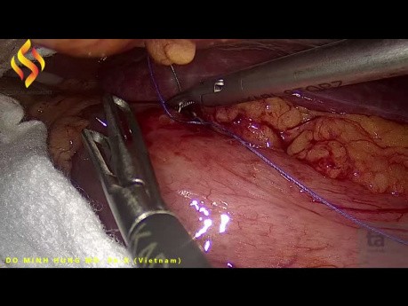 Lap Removal of Foreign Body Punctured the Stomach Wall