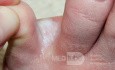 Interdigital Tinea pedis