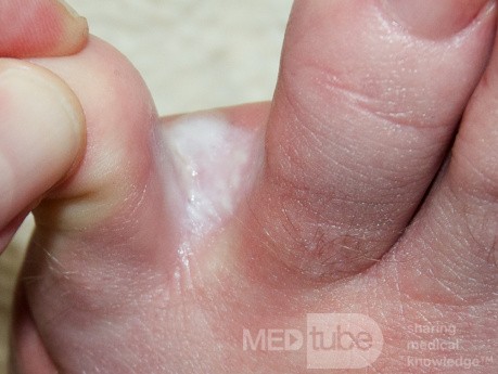 Interdigital Tinea pedis