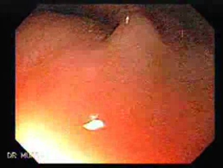 Gastrointestinal Stromal Tumor - GIST (1 of 13)