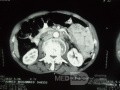 Pancreas cancer - 7