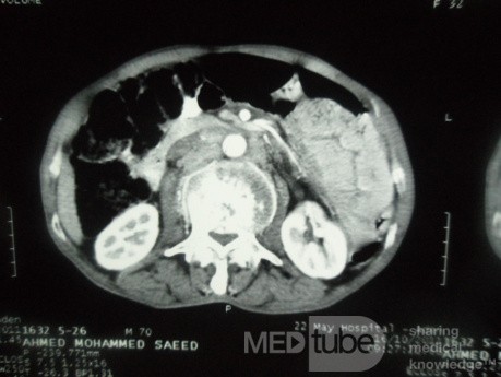 Pancreas cancer - 7
