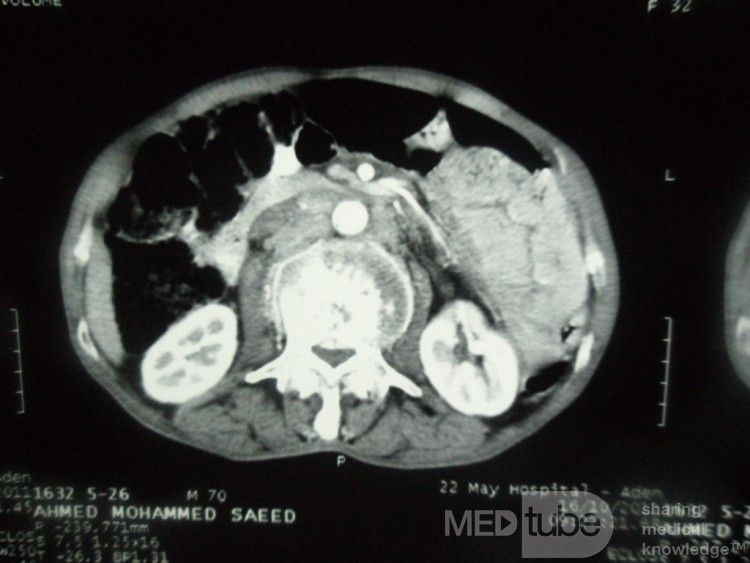 Pancreas cancer - 7