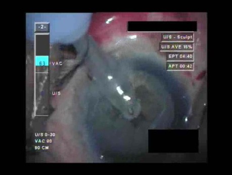 Cataract Surgery X - Part 2