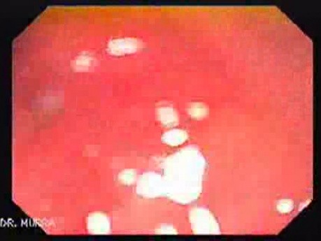 Pre - Pyloric Ulcer - Endoscopy (3 of 9)