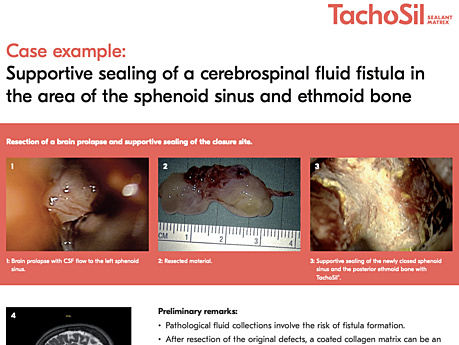 Supportive Sealing of a Cerebrospinal Fluid Fistula in the Area of the Sphenoid Sinus and Ethmoid Bone, Prof. Jürgen Piek