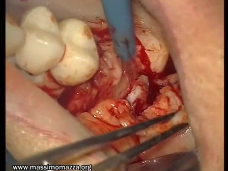 Intra-Grafting Procedures (1/2)