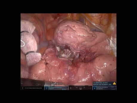 Unedited Robotic Right Upper Pulmonary Lobectomy