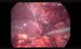 Total Proctocolectomy And Ileal J Pouch Ileoanal Anastomosis