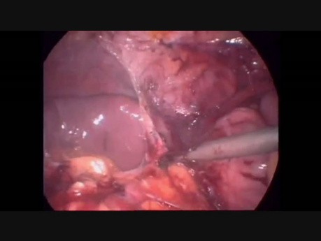 Total Proctocolectomy And Ileal J Pouch Ileoanal Anastomosis