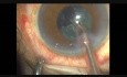 Shorting Steps in Cataract Surgery, Femtophaco