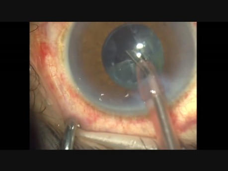 Shorting Steps in Cataract Surgery, Femtophaco