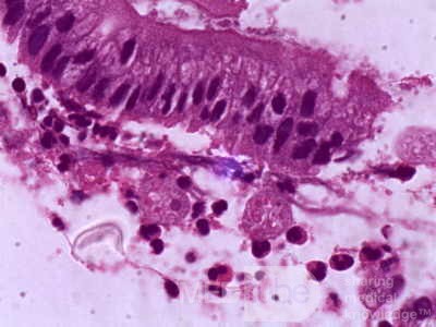 Histopathology of Amebiasis