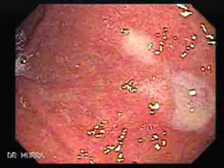 Systemic Lupus Erythematosus - Stomach finding (7 of 7)