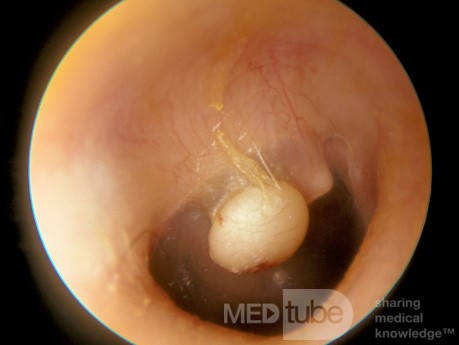 Congenital Epiderman Cyst of the Tympanic Membrane