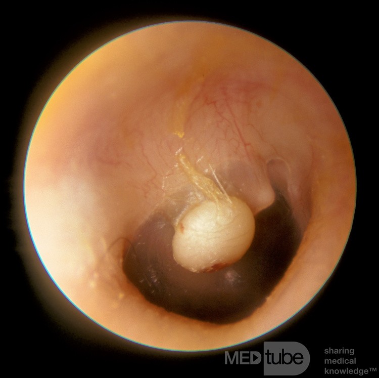 Congenital Epiderman Cyst of the Tympanic Membrane