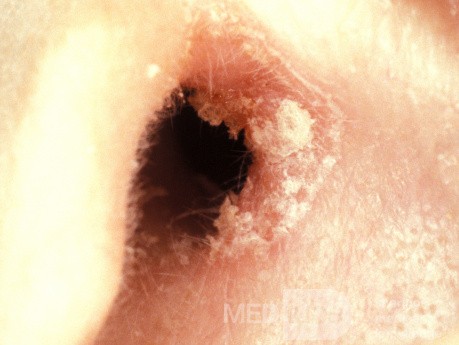 Psoriasis Vulgaris External Canal