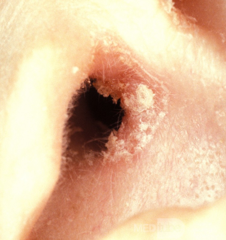 Psoriasis Vulgaris External Canal