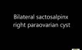  Bilateral sactosalpinx right paraovarian cyst