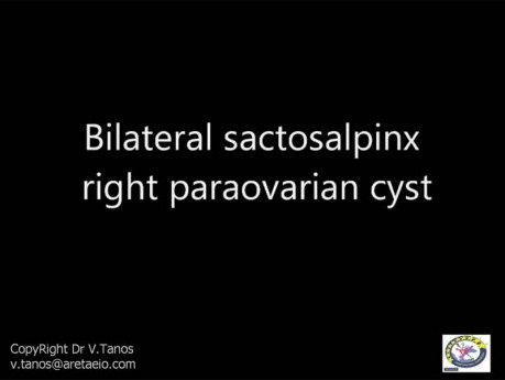  Bilateral sactosalpinx right paraovarian cyst